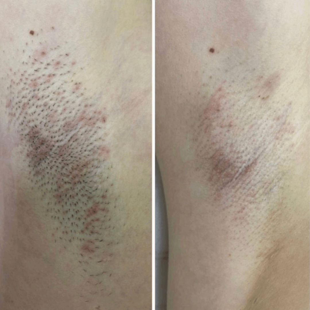 5 сеансов лазерной эпиляции