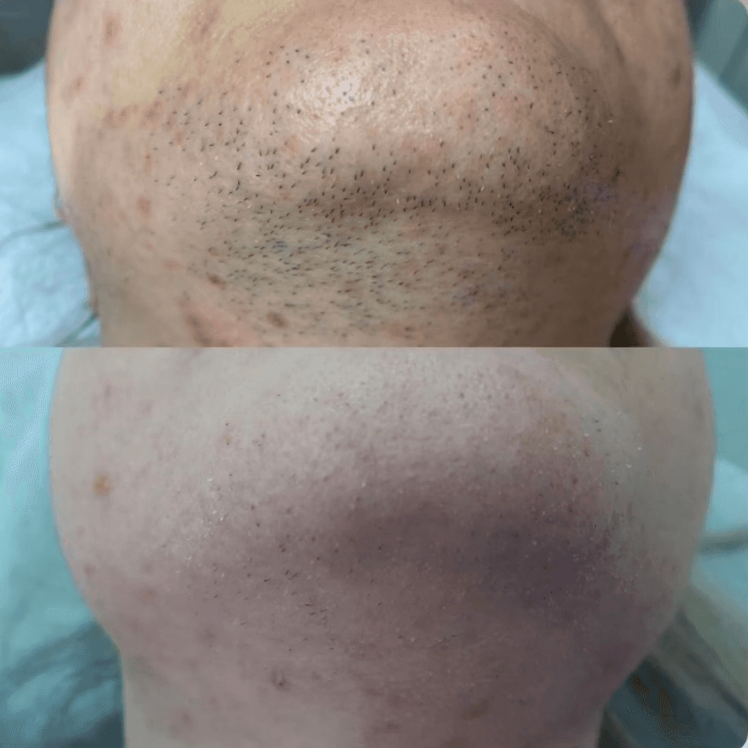 7 сеансов лазерной эпиляции