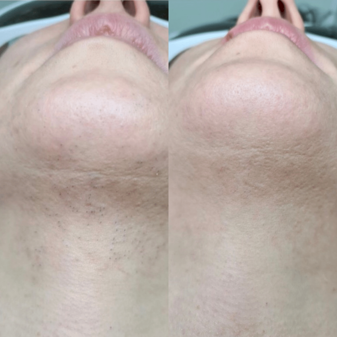 6 сеансов лазерной эпиляции