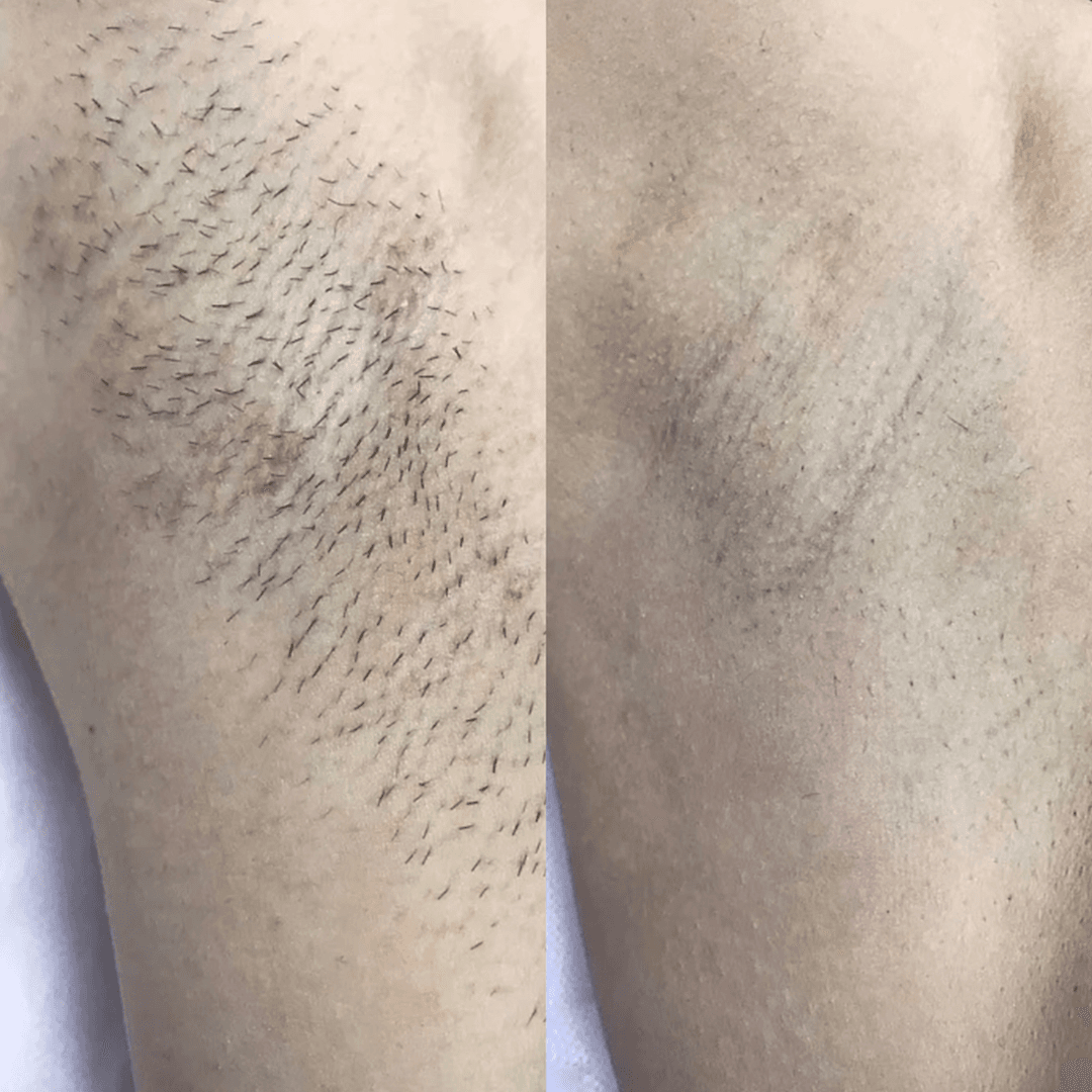 5 сеансов лазерной эпиляции