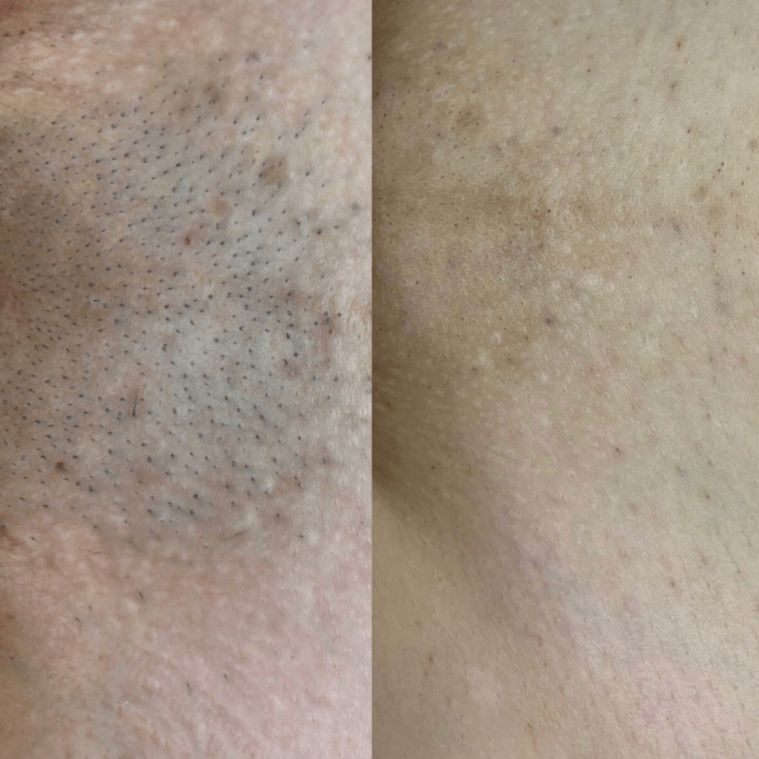 8 сеансов лазерной эпиляции