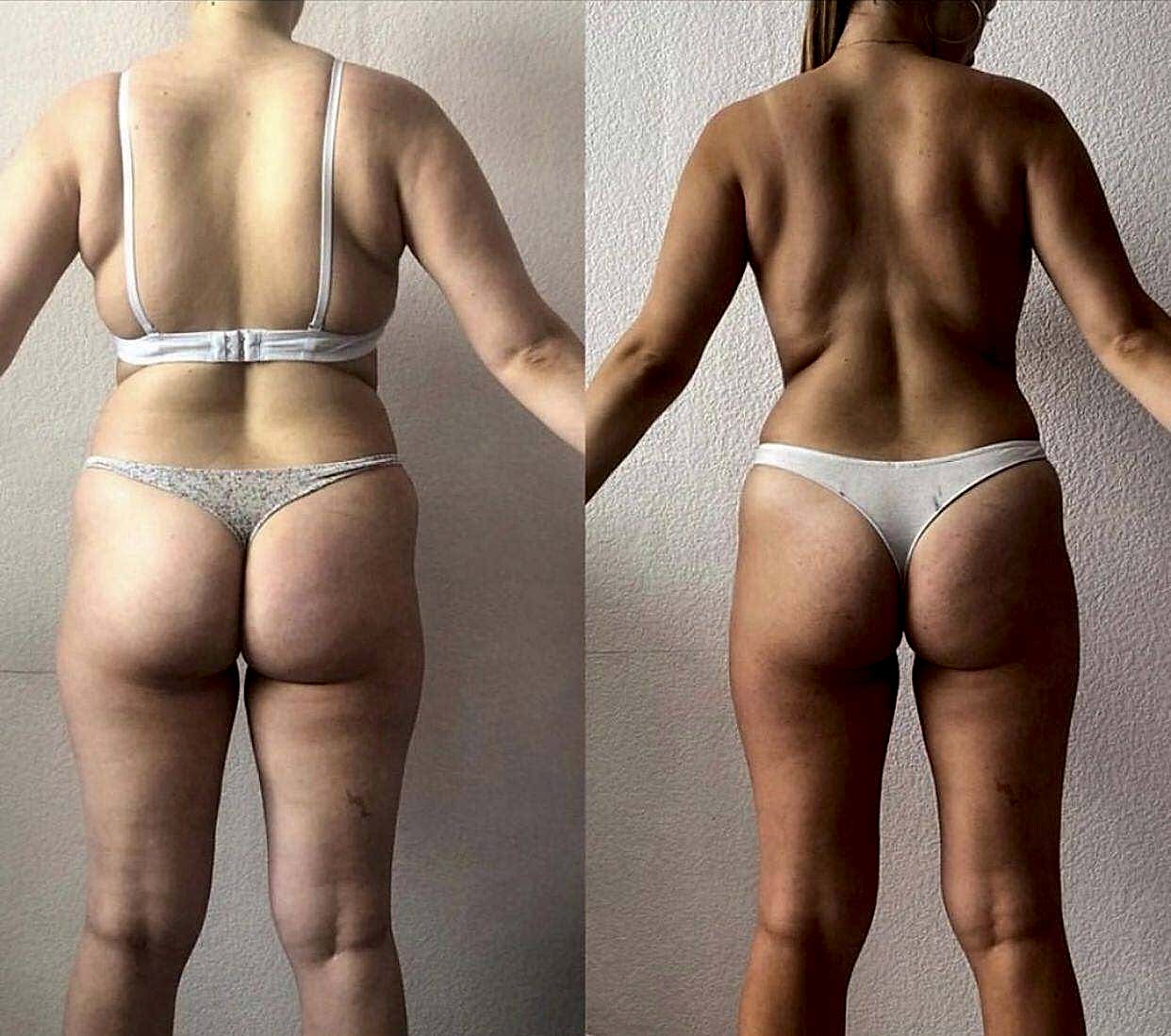 Пройден курс LPG  массажа 