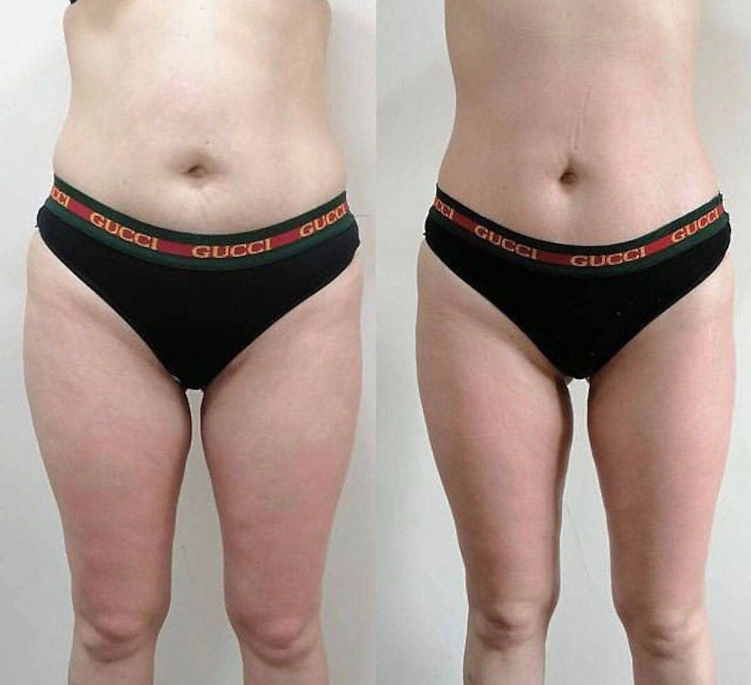 Пройден курс LPG  массажа 