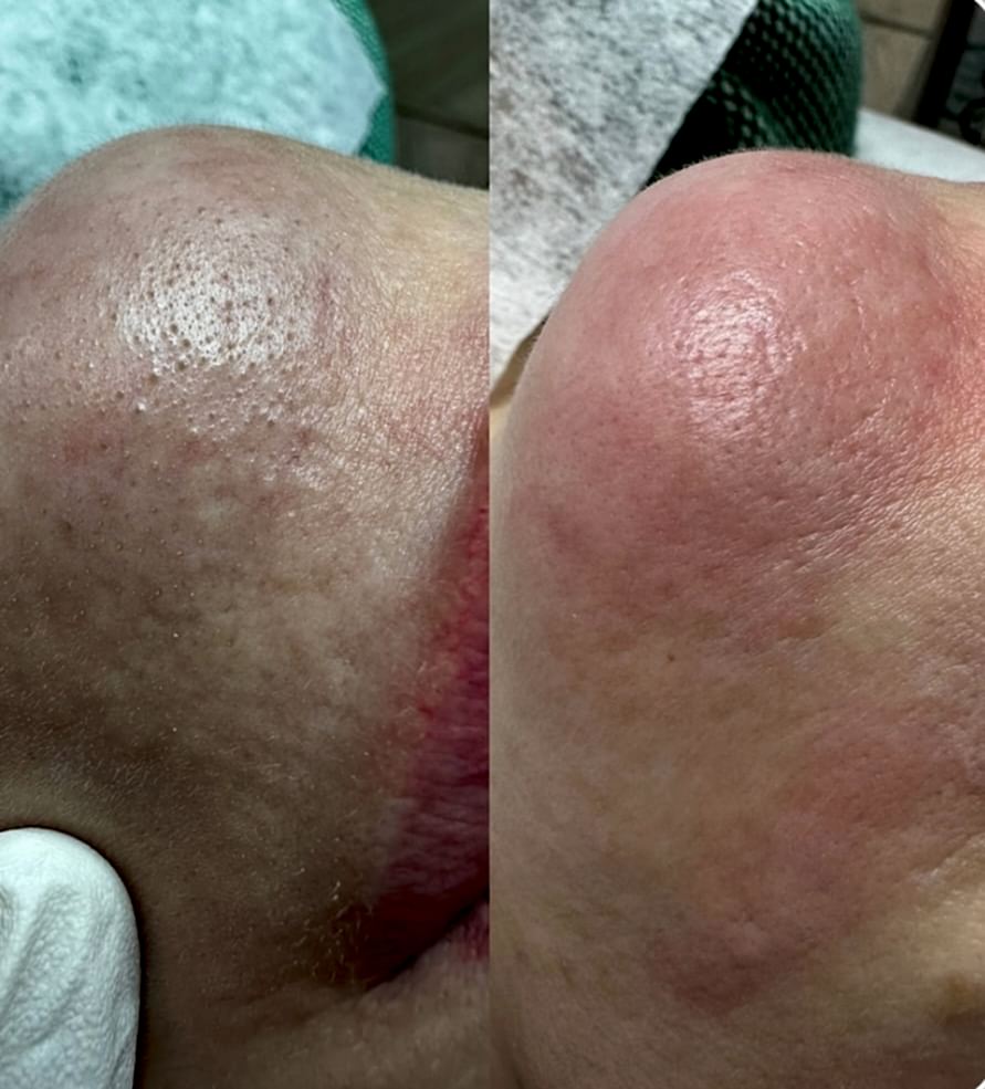 Ультразвуковая чистка лица