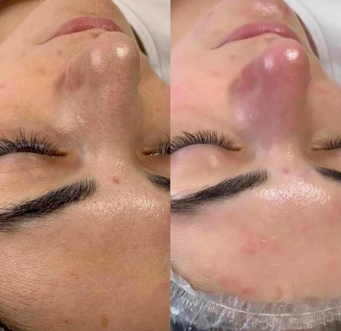 Ультразвуковая чистка лица