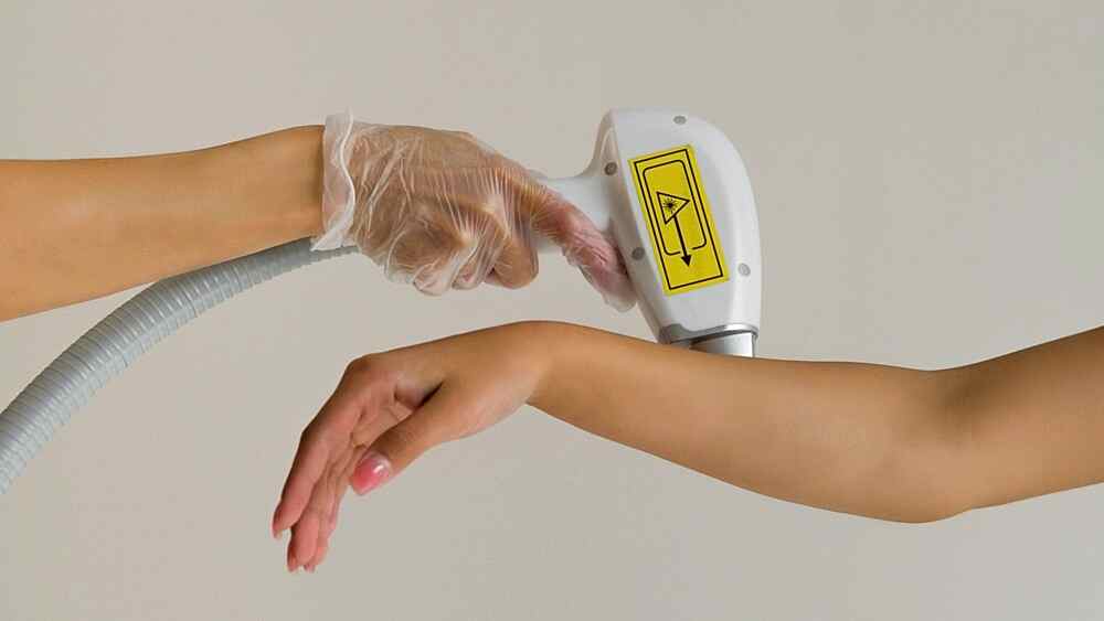 Лазерная эпиляция